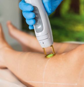 Laser ontharen onderbenen - Stralend - De GentleMax PRO